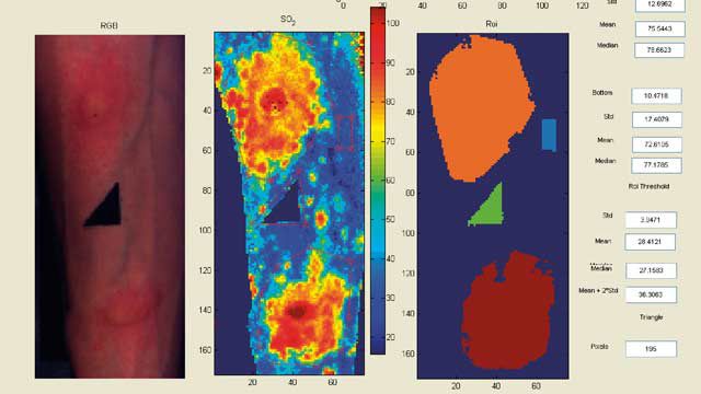 來自諾丁漢大學的高光譜圖像，通過將光線照射在組織表面并準確測量氧氣水平并生成血氧飽和度圖而得出，以方便臨床研究人員和醫生的工作。